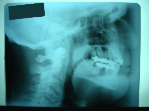 After Hyoid