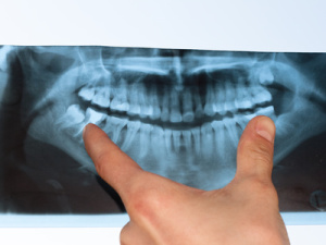 Dental X-Ray panoramic