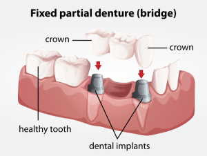 Fixed partial denture bridge